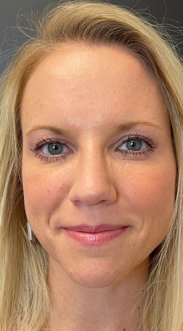 The same NeoMed Spa patient after treatment