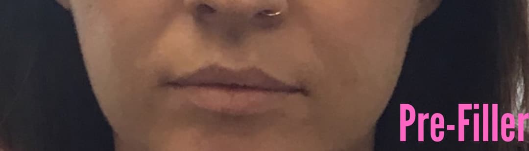 Restylane and Lip Filler
